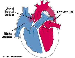ASD Heart Defect
